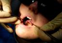 Dozens of hospital admissions in Dudley to remove children's rotten teeth